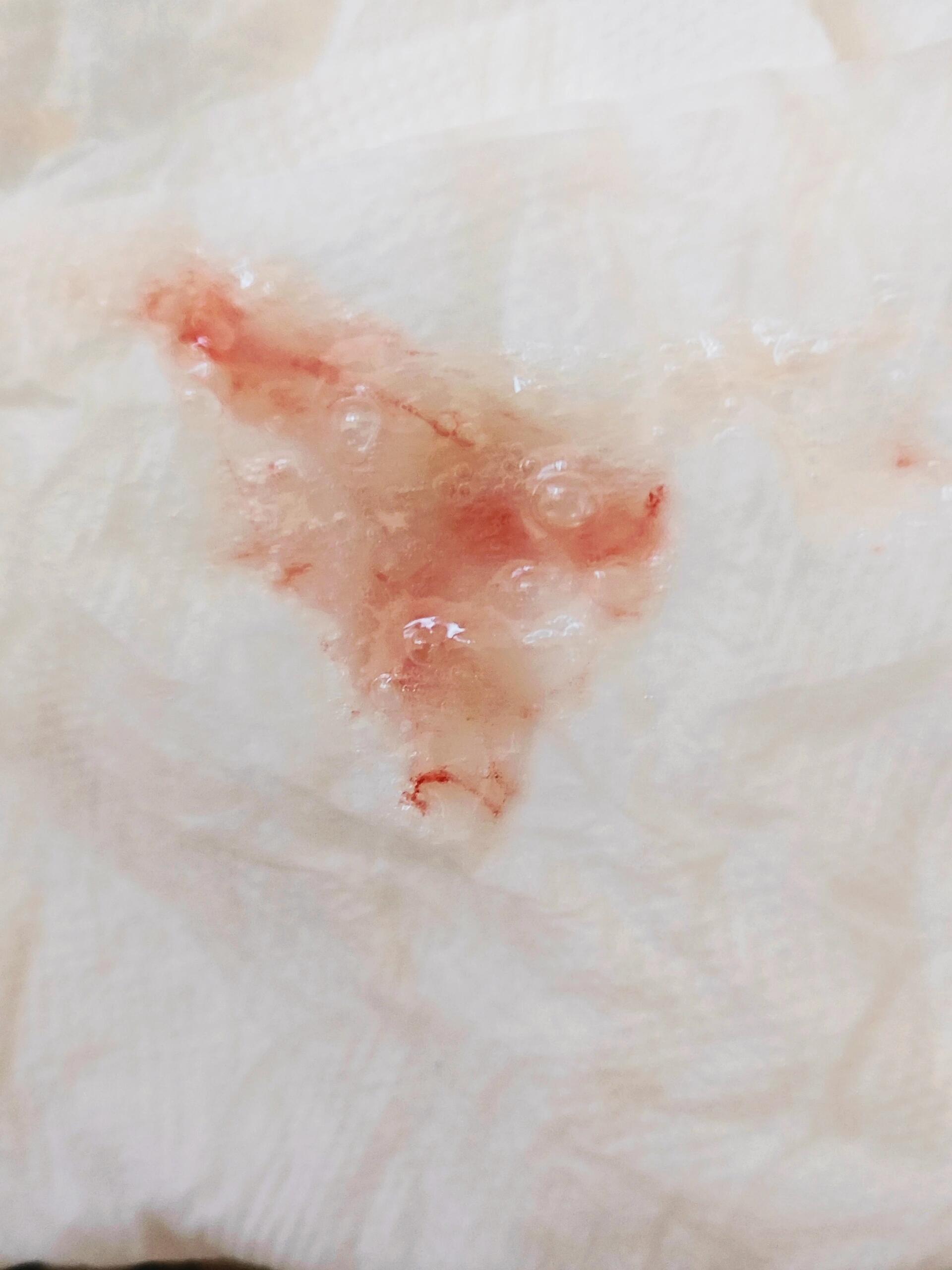 记录首次新冠感染,咳出血来