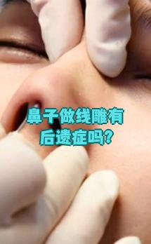 线雕隆鼻是用埋线方式抬高鼻梁,改善鼻梁凹陷或鼻小柱短的问题