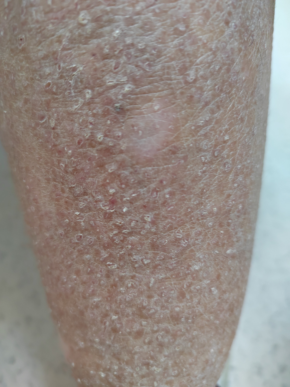 双侧小腿部位密集丘疹肥厚斑块症状.中央间有脱色白斑.