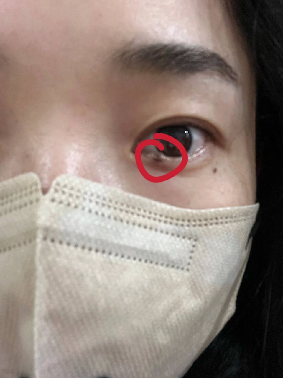 左眉尾和右眼角各有一颗突出的痣,体检时候医生说眼角的痣经常摩擦,最