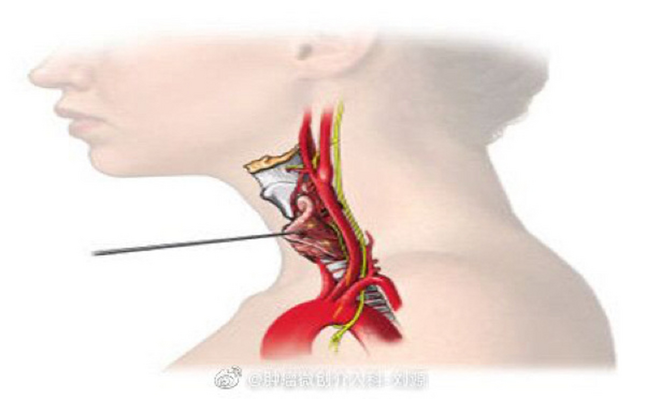 甲状腺结节消融术优点和缺点都相对明确