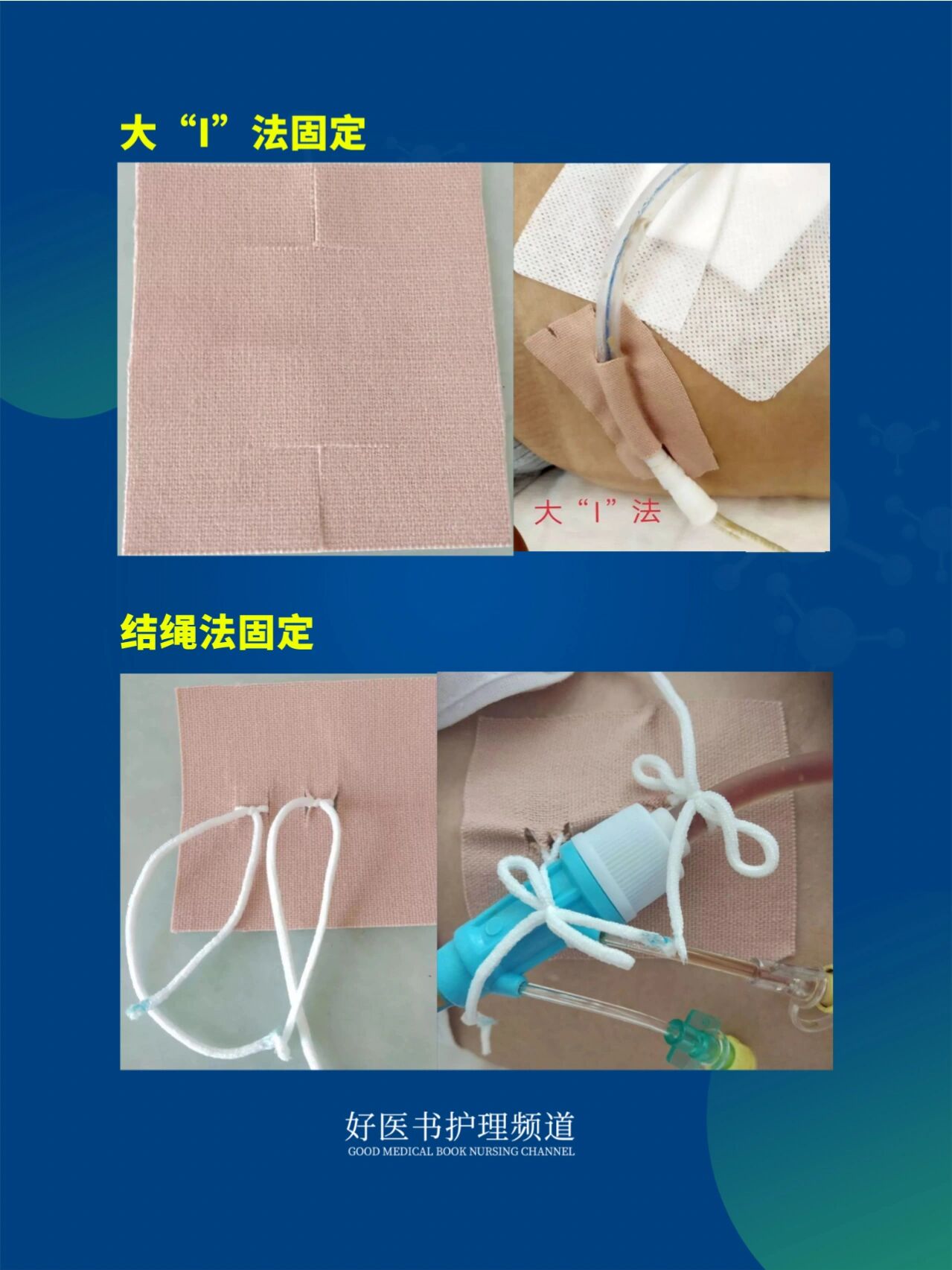护士必知978种引流管固定方法@慢慢巡漫漫路的动态