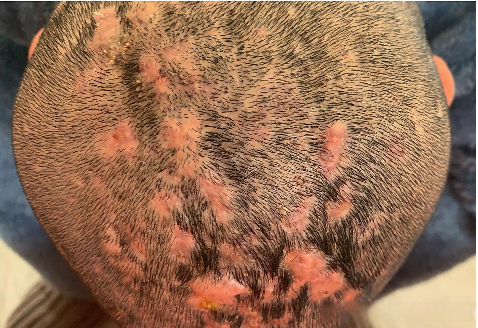 有些人头上疙疙瘩瘩的,长了很多大鼓包,用手一摁,能感觉到里面有很多