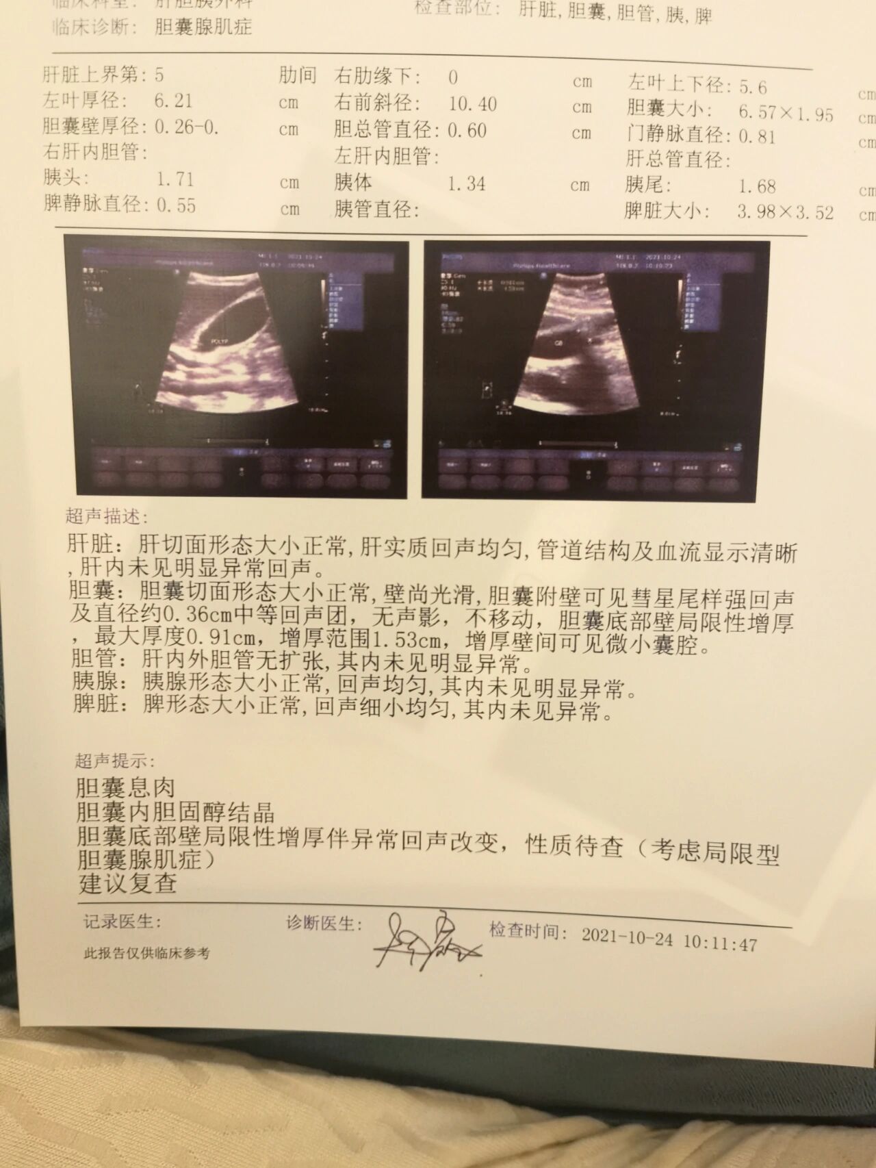 胆囊腺肌症