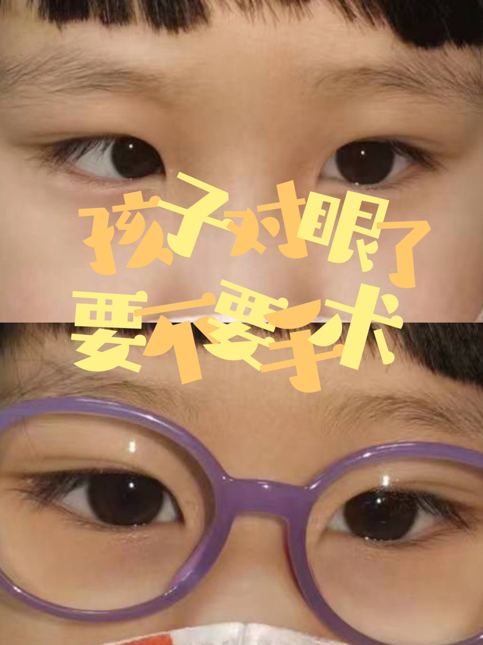 等等看 今天分享的案例是一个典型的调节性内斜视.