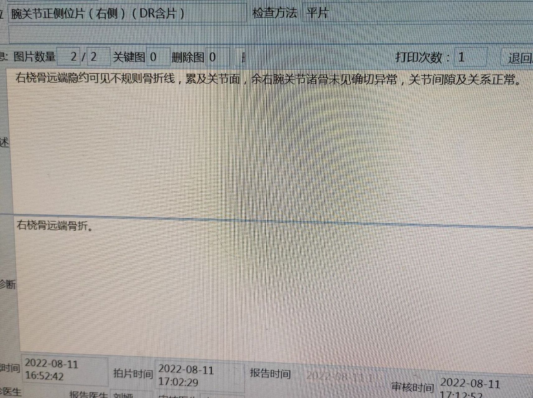 腕关节正侧位(右侧)