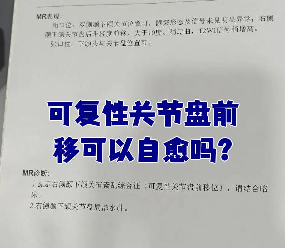 可复性关节盘前移(也叫可复性关节盘前移位)通常无法自愈,需要治疗