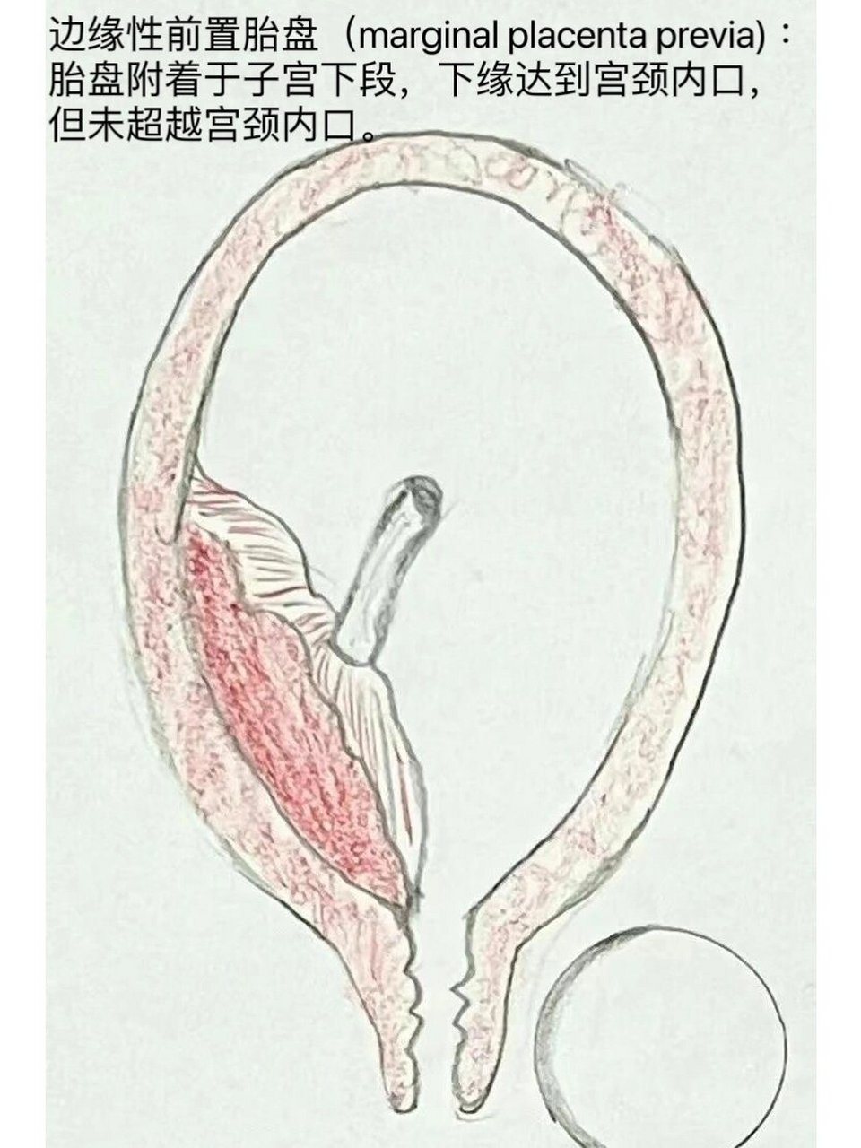 妊娠28周以后,胎盘位置低于胎先露部,附着在子宫下段,下缘达到或父乔