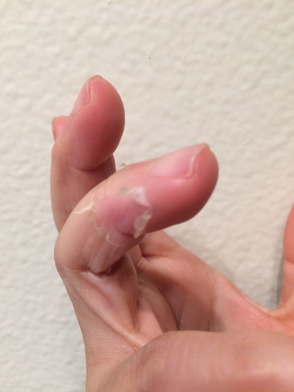 女性健康# 手上是剥脱性角质松解症又称层板