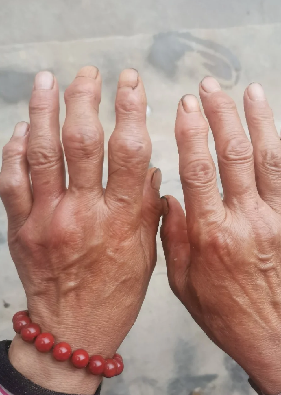 手风湿性关节炎的症状有哪些?