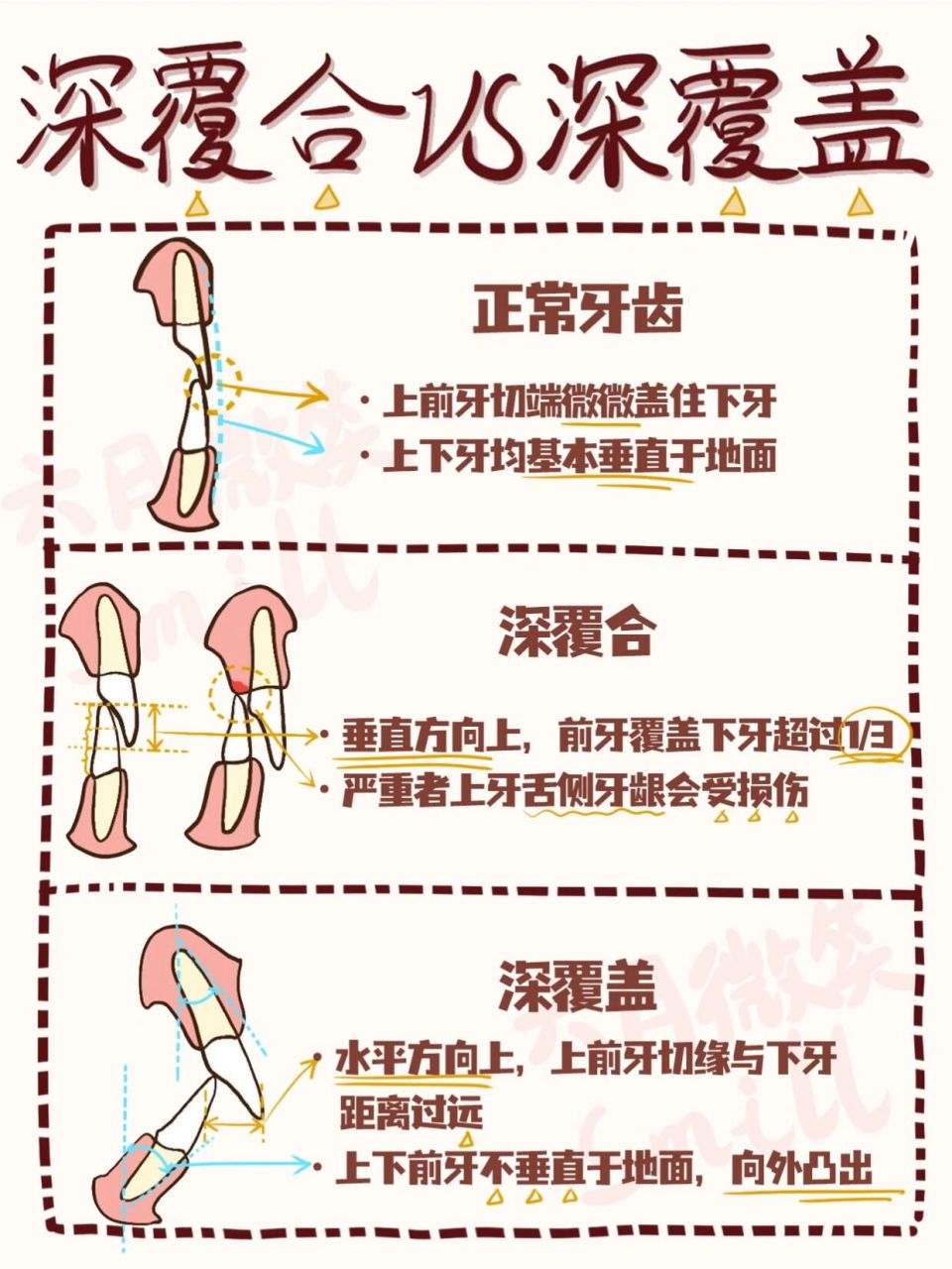 牙齿深覆合和深覆盖图片