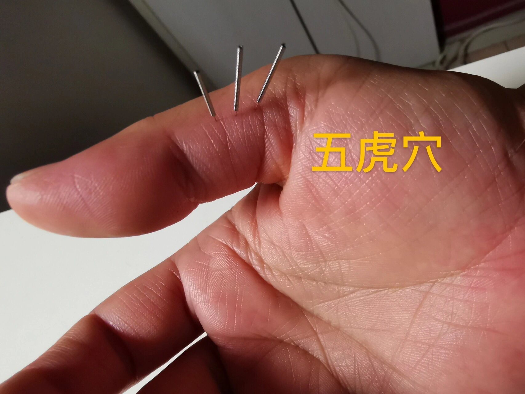 针话第38集|董氏针灸之【手足麻木】 手足麻木很多都是因为长期颈椎病