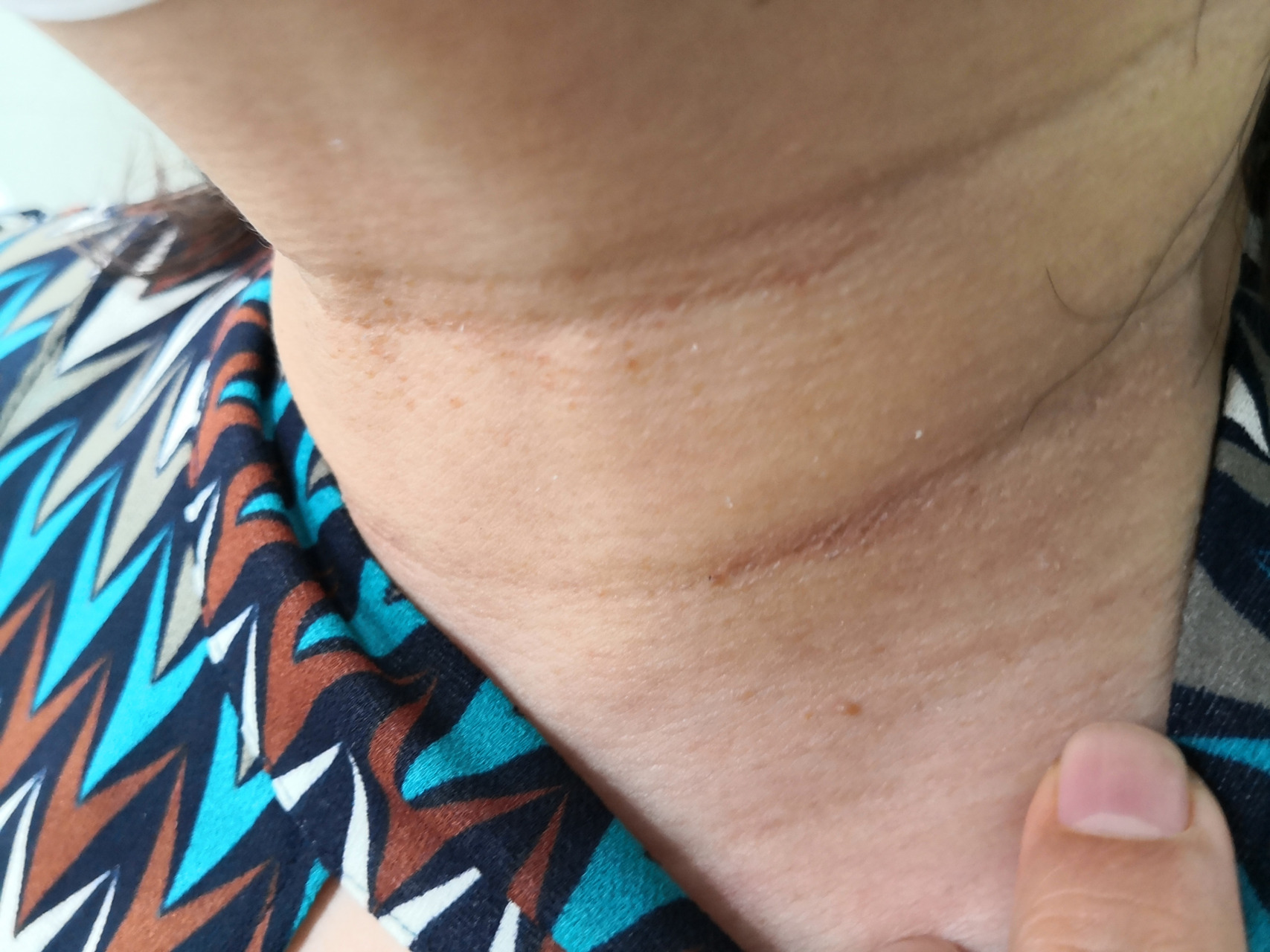 颈部皮赘症状和夏季皮炎症状#解决皮肤问题专注皮肤美容##夏季皮炎