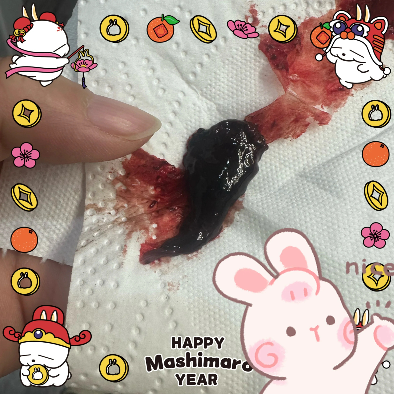 子宫内膜息肉的姐妹,狠狠艾灸吧!