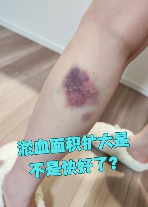 淤血是外力撞击导致皮下毛细血管破裂出血引起的
