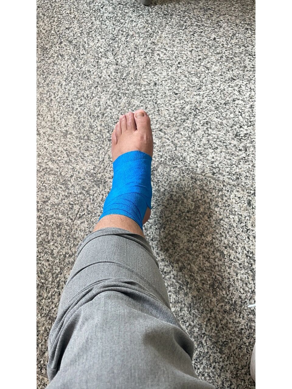 左腿踝关节外侧腓骨远端撕脱性骨折 6.
