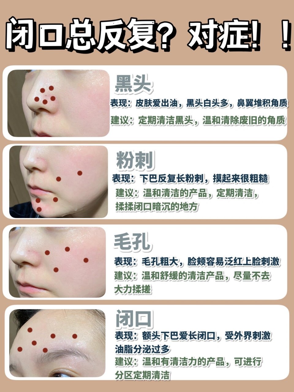 摸起来疙疙瘩瘩的 尤其是夏天的时候,闭口很难消掉 反反复复的闭口真