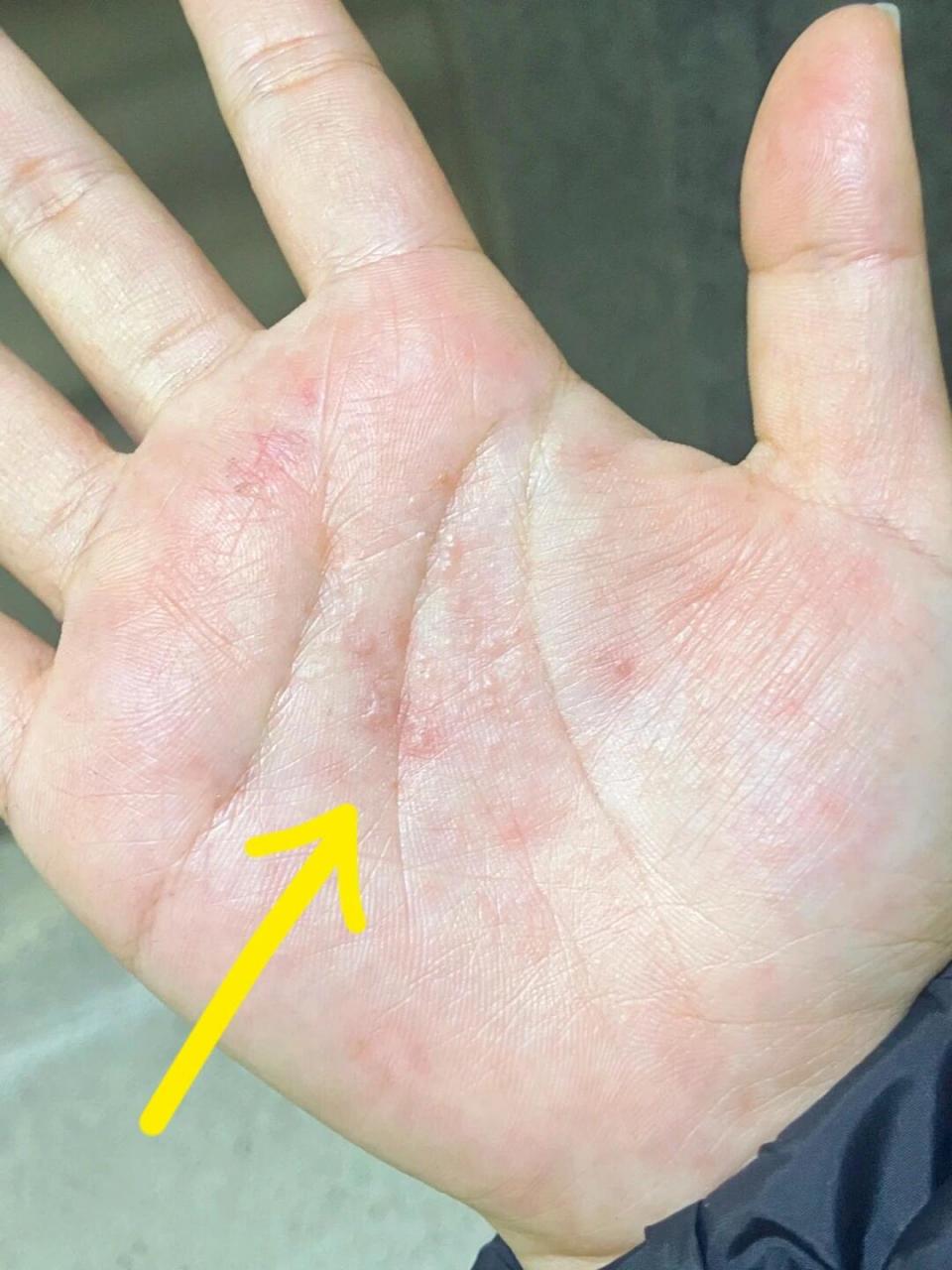 手心长这个痒到不行… 手心长这个痒到不行……这个方法不管用你打我!