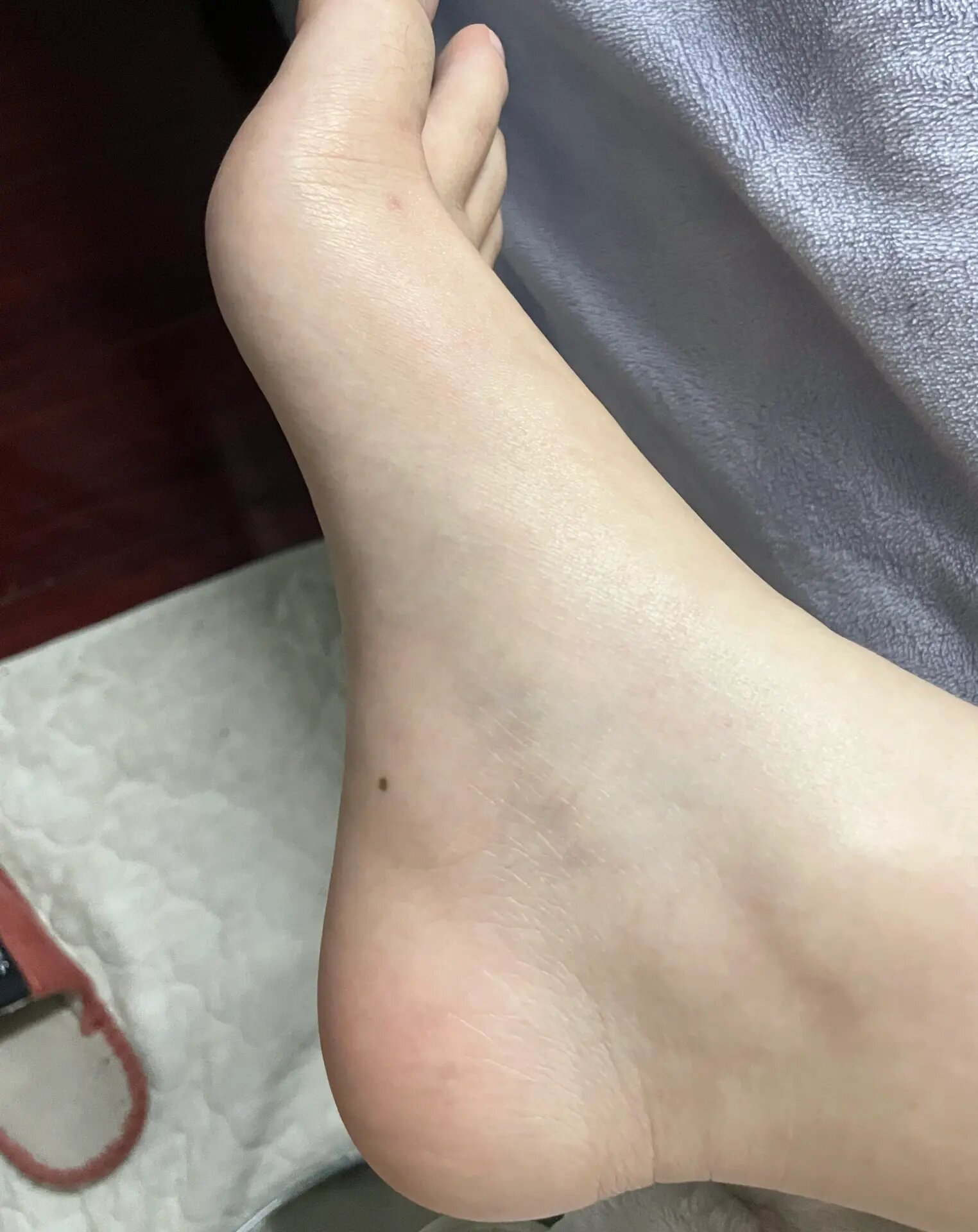 脚的侧面有痣