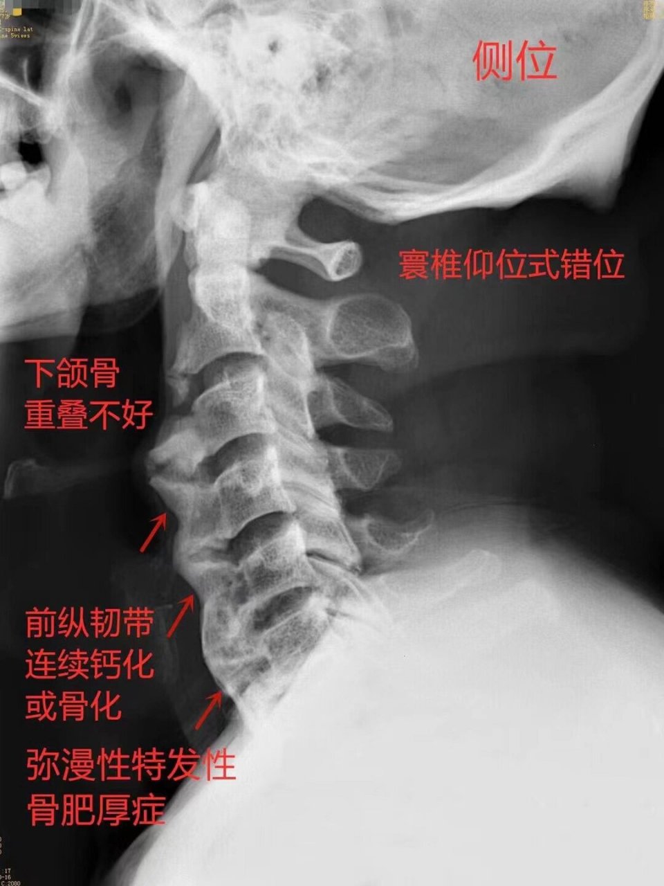 椎小关节骨质增生图片