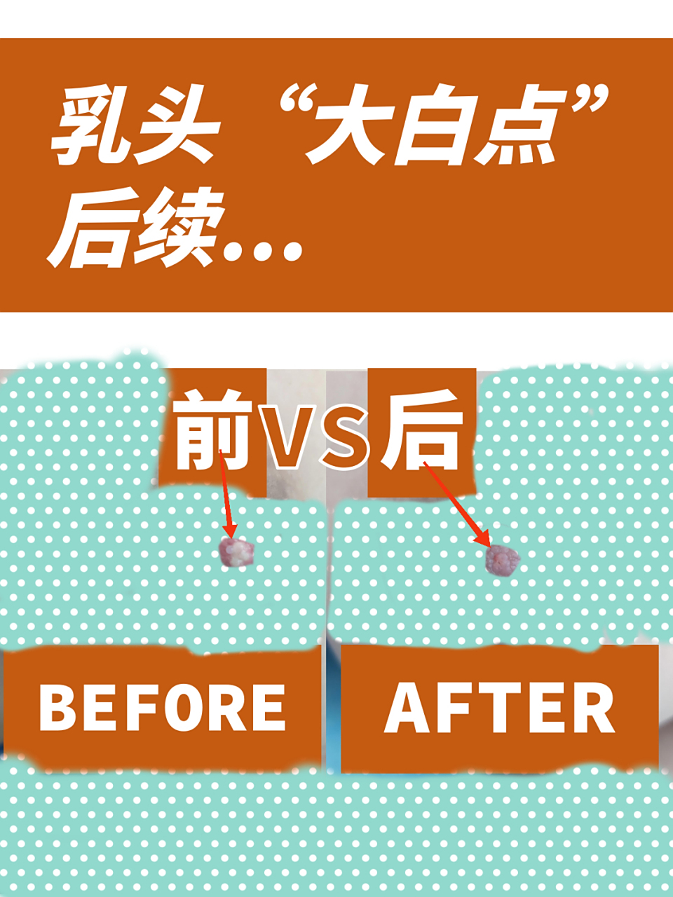 乳头"白点",治疗前后两天对比 打码成这样,同款宝妈看得懂[捂脸][捂脸