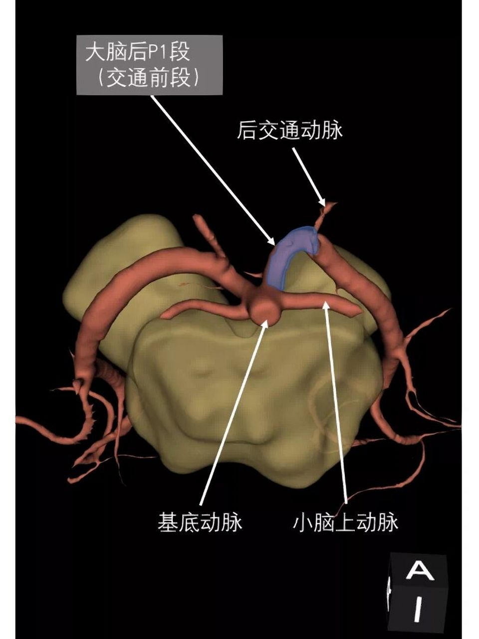 大脑后动脉p1段图片