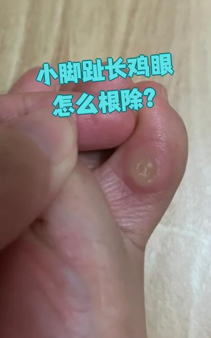 小脚趾长鸡眼想彻底治好,主要有三种方法:用药,物理治疗和手术