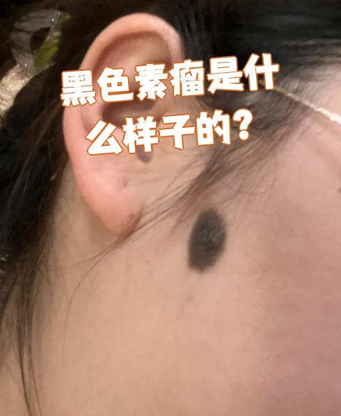 黑色素瘤是一种由黑色素细胞恶变形成的肿瘤