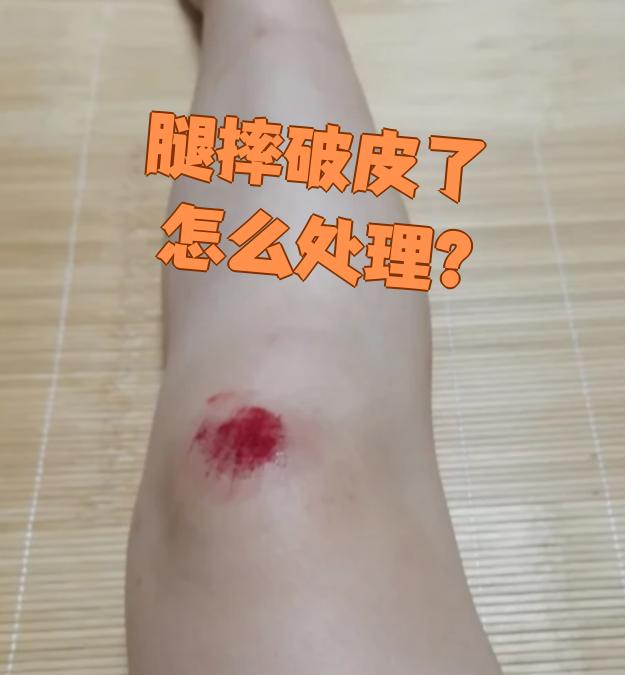 腿摔破皮了,先别慌,按伤口情况分三步处理就行