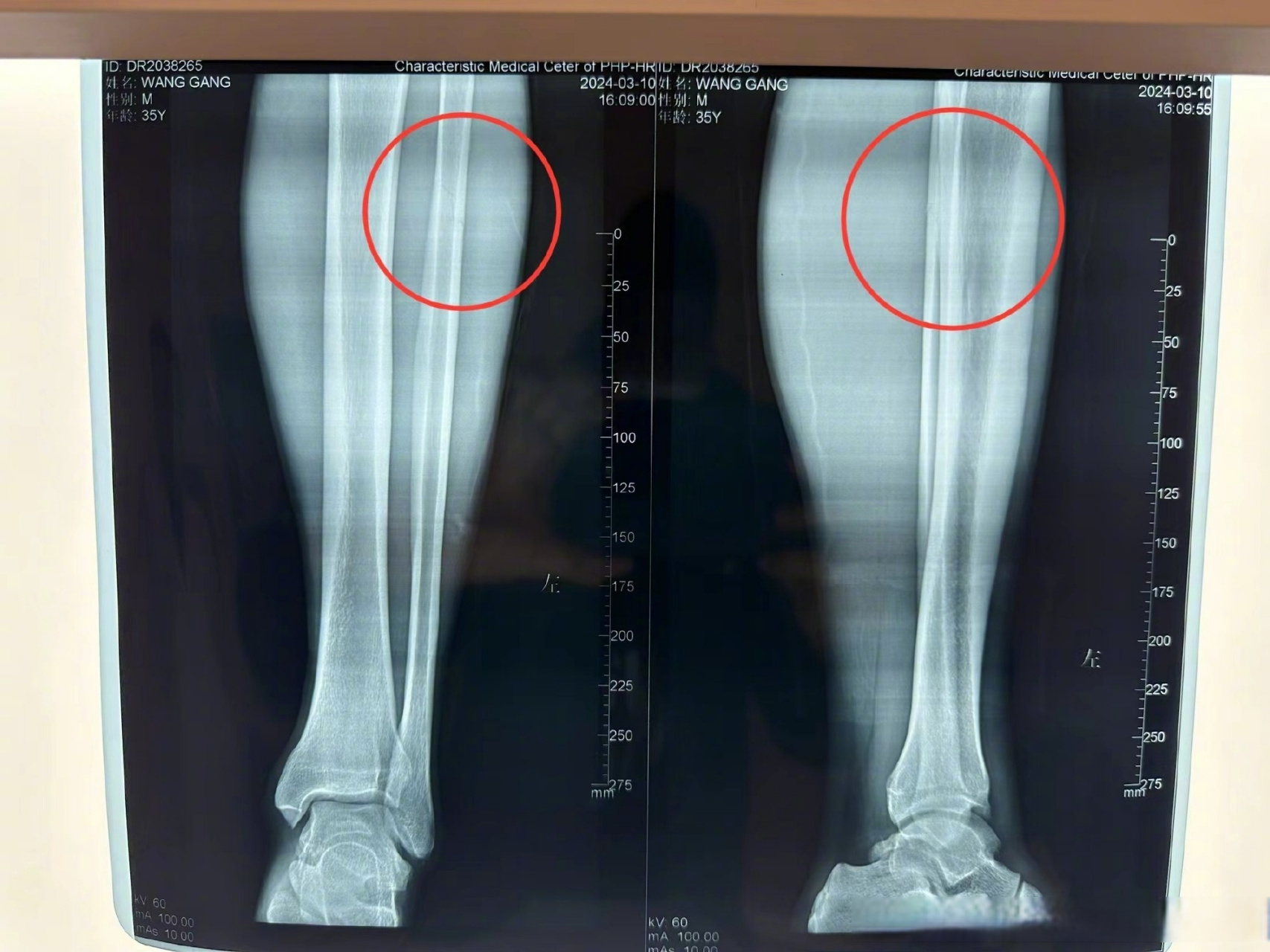 国安官方:王刚左小腿中上段腓骨裂纹骨折