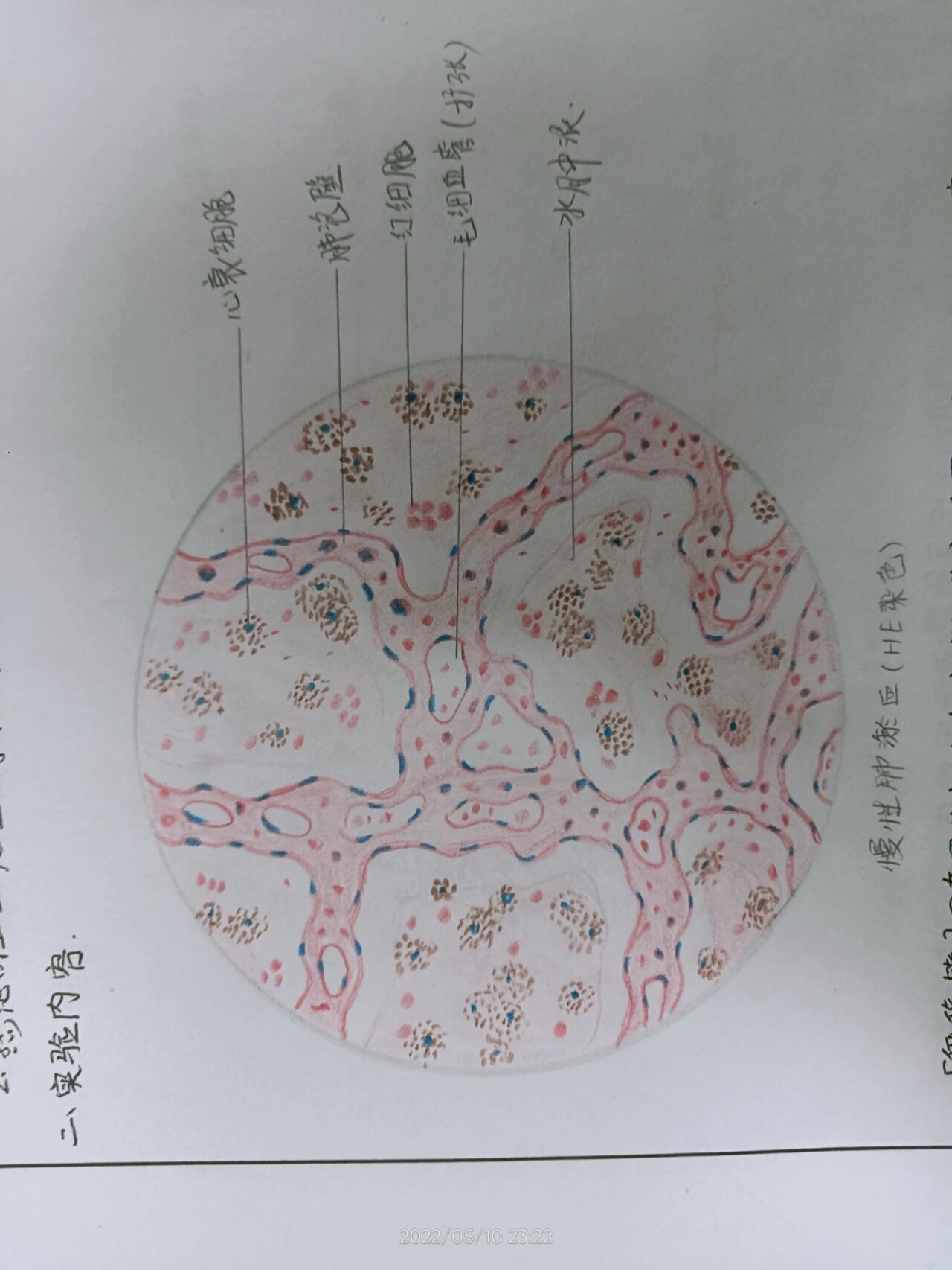 病理切片红蓝铅笔绘图 1 慢性肺淤血2