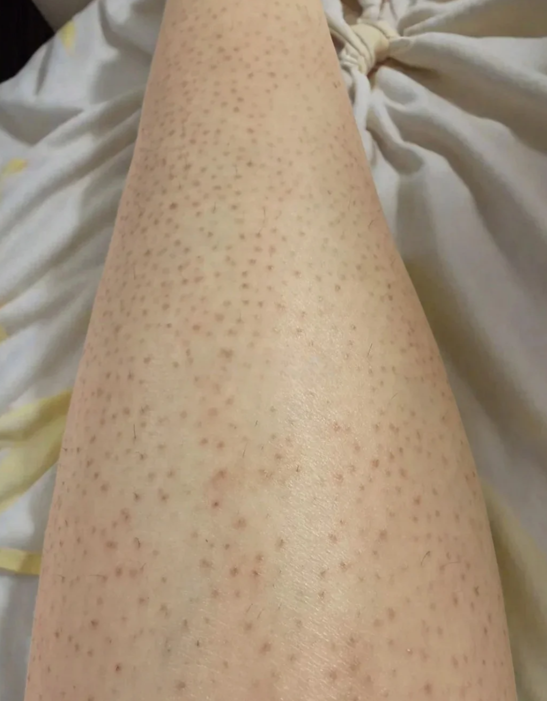 腿上皮肤摸起来不光滑,有小颗粒感,常见原因包括毛周角化病,毛囊炎