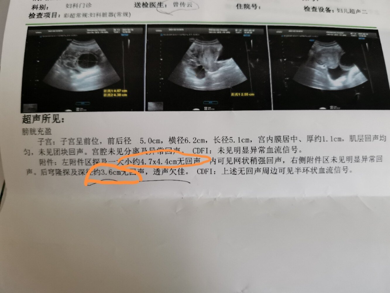 黄体破裂&黄体血肿 做了5次彩超 慢慢变好