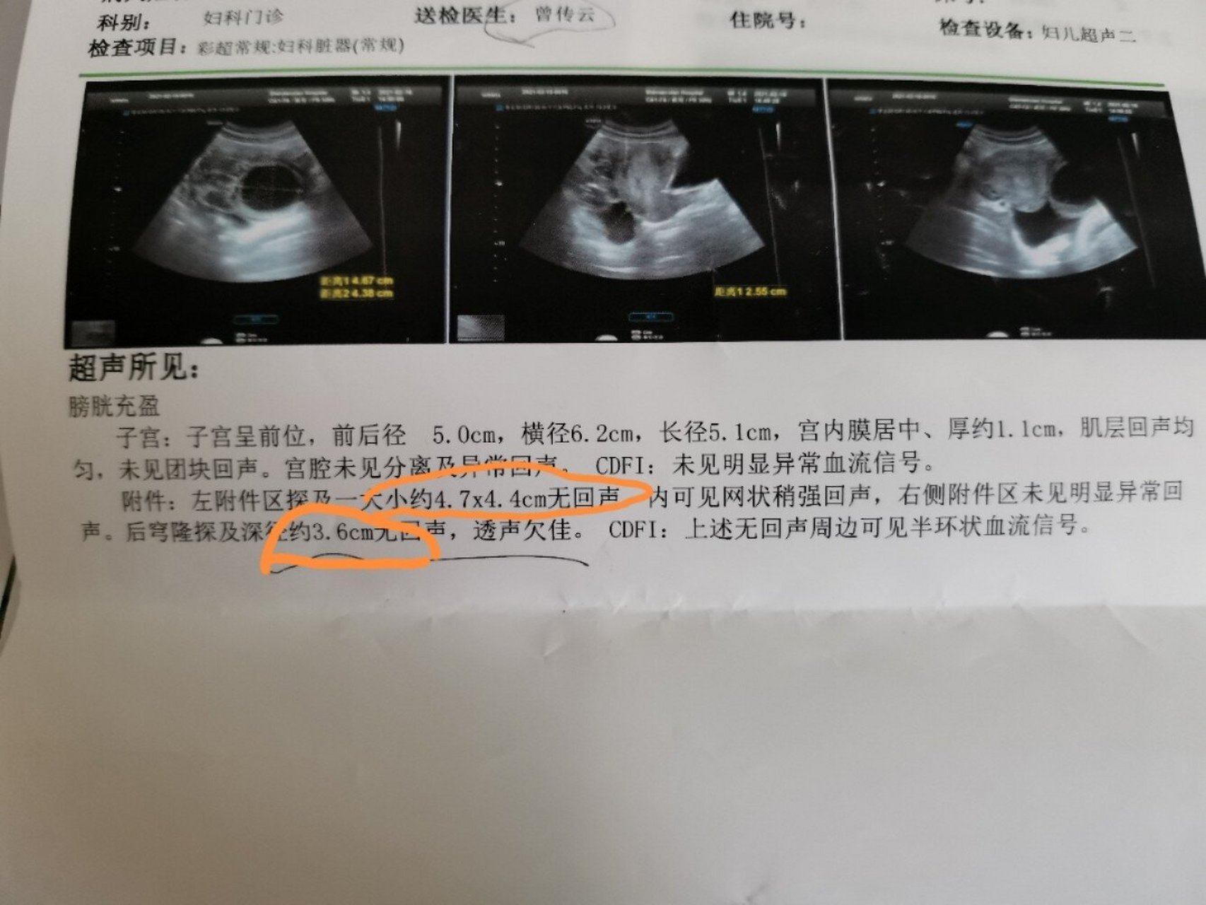 黄体破裂&黄体血肿 做了5次彩超 慢慢变好 肚子微微有点胀  持续了一
