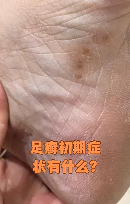 这种病是真菌感染引起的,容易在脚趾缝,脚底,脚跟和脚侧边出现,会传染