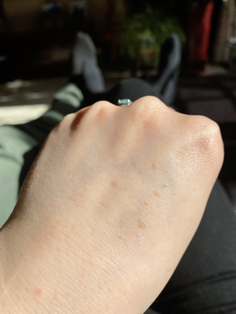 手背长的像斑的东西 这是什么?