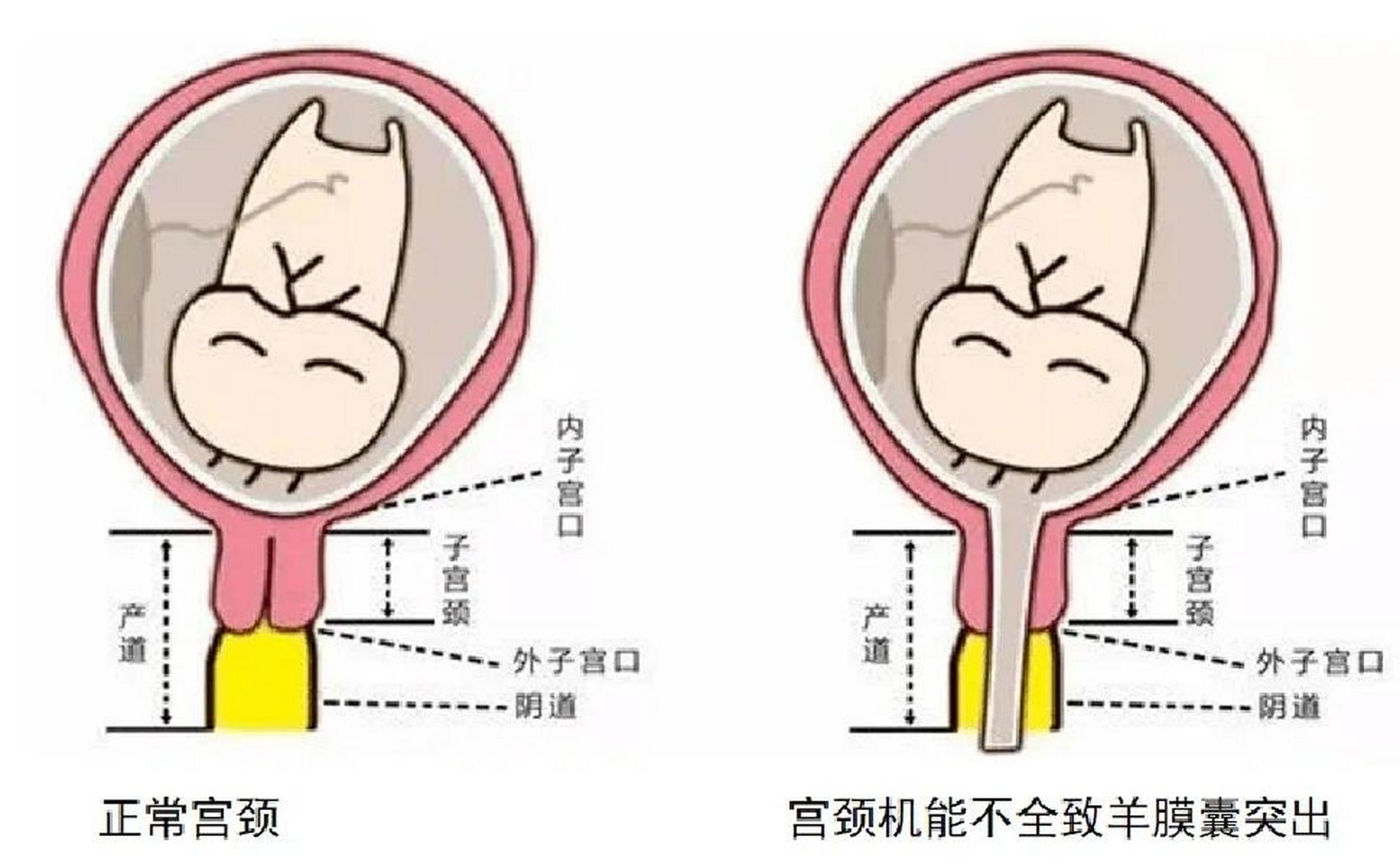 宫腔分离图解图片