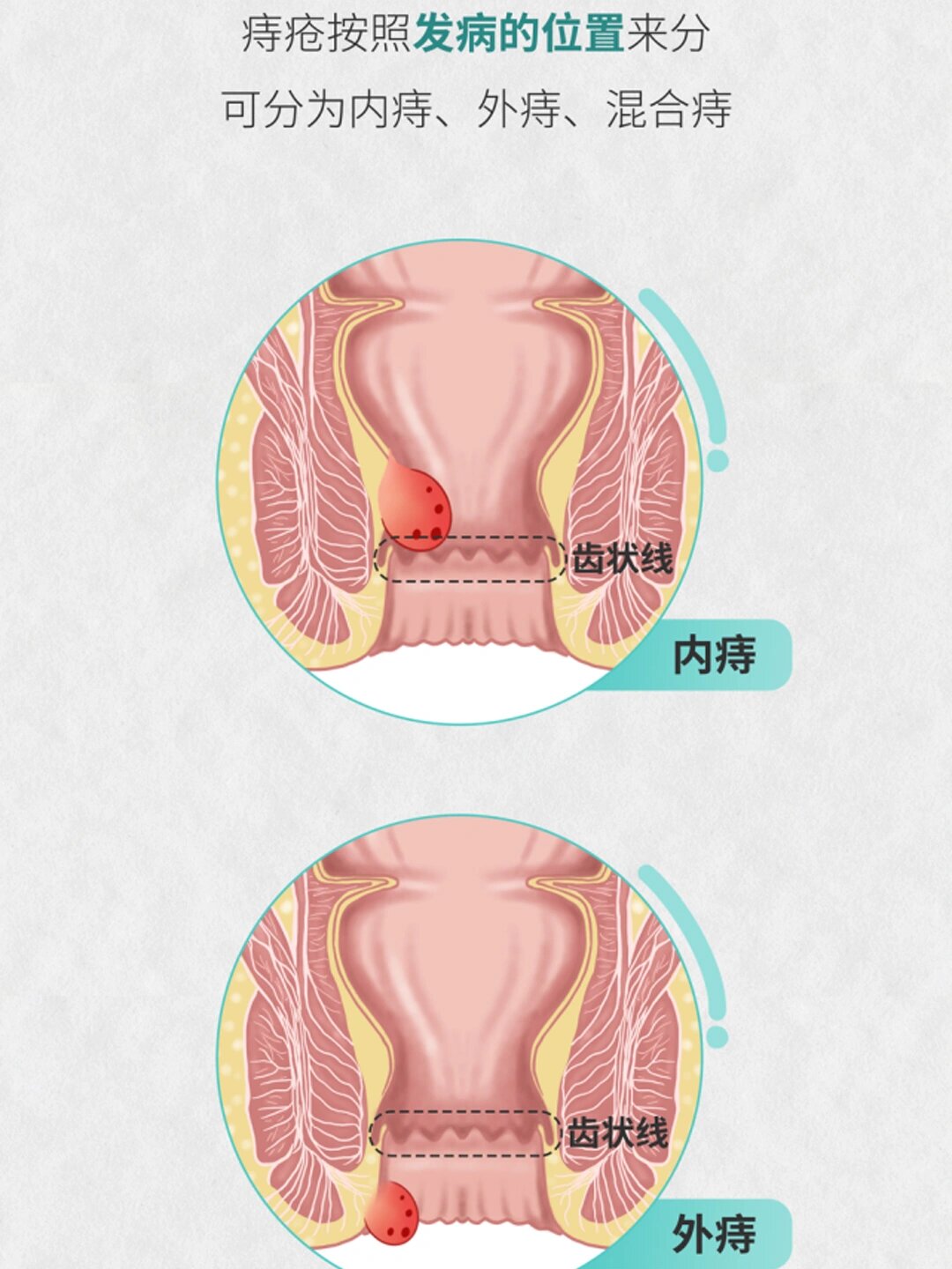 你是哪种痔疮类型 混合痔:混合痔包含了内痔,外痔的所有症状,初识于