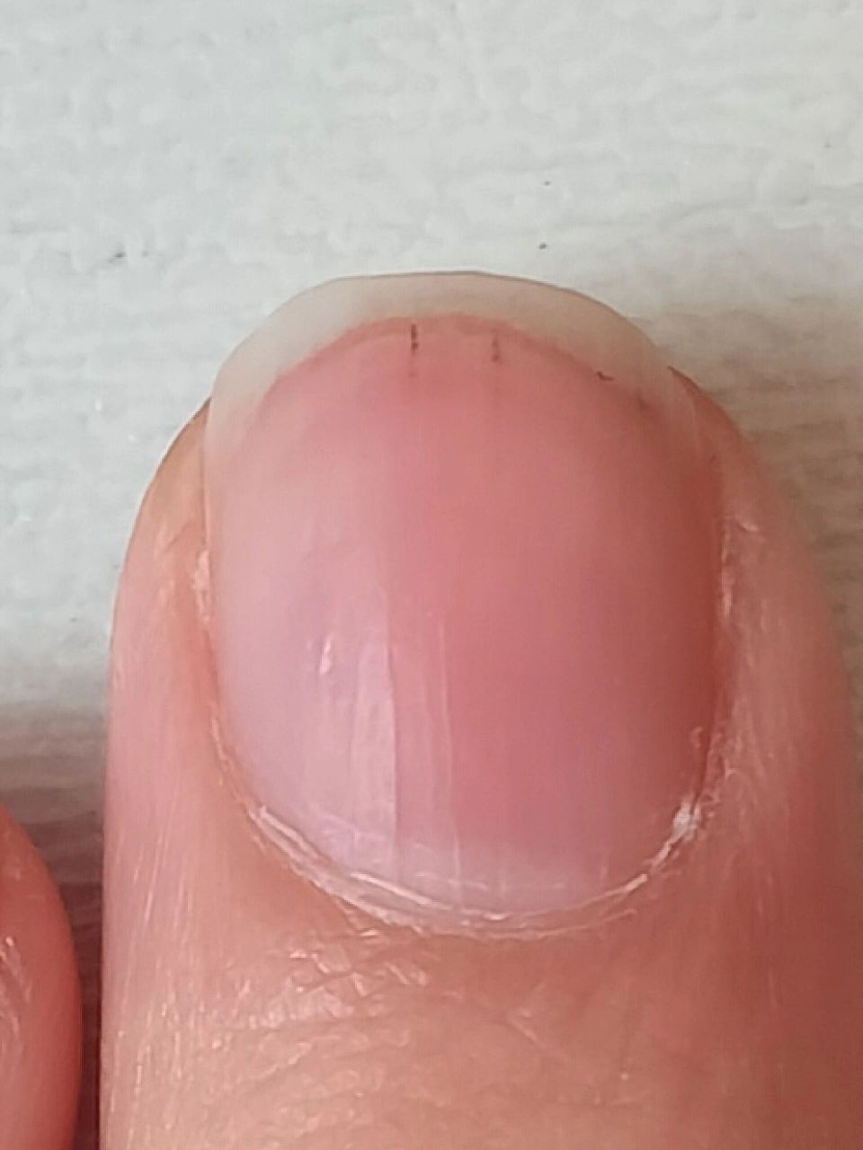 指甲上有两条黑线,图一是昨天早上拍的,图二今天下午拍的,这是咋了
