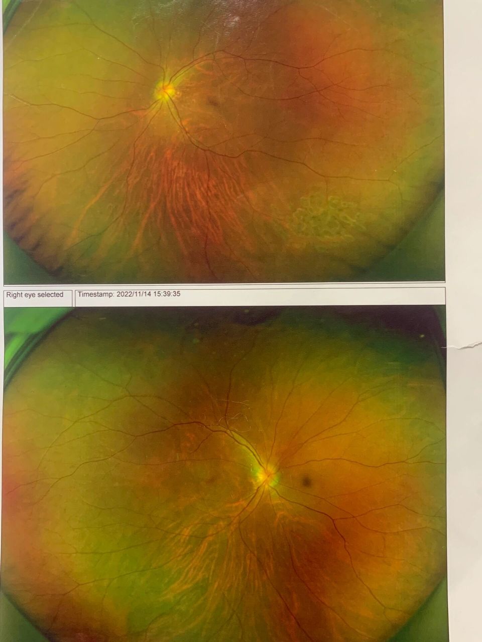 双眼视乳头水肿 七月开始觉得近视加深,不过影响不大.