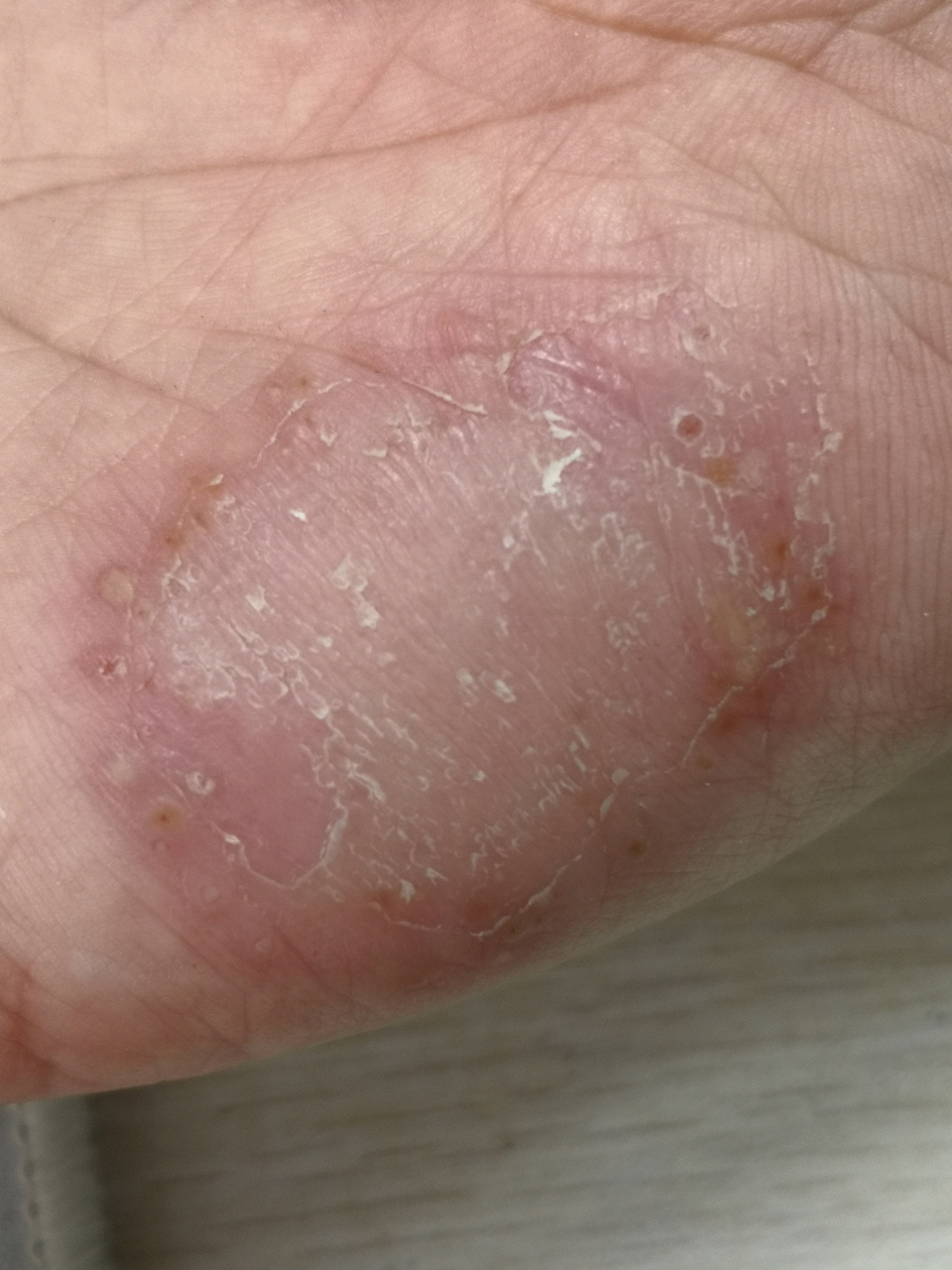 手掌水疱脓疱症状