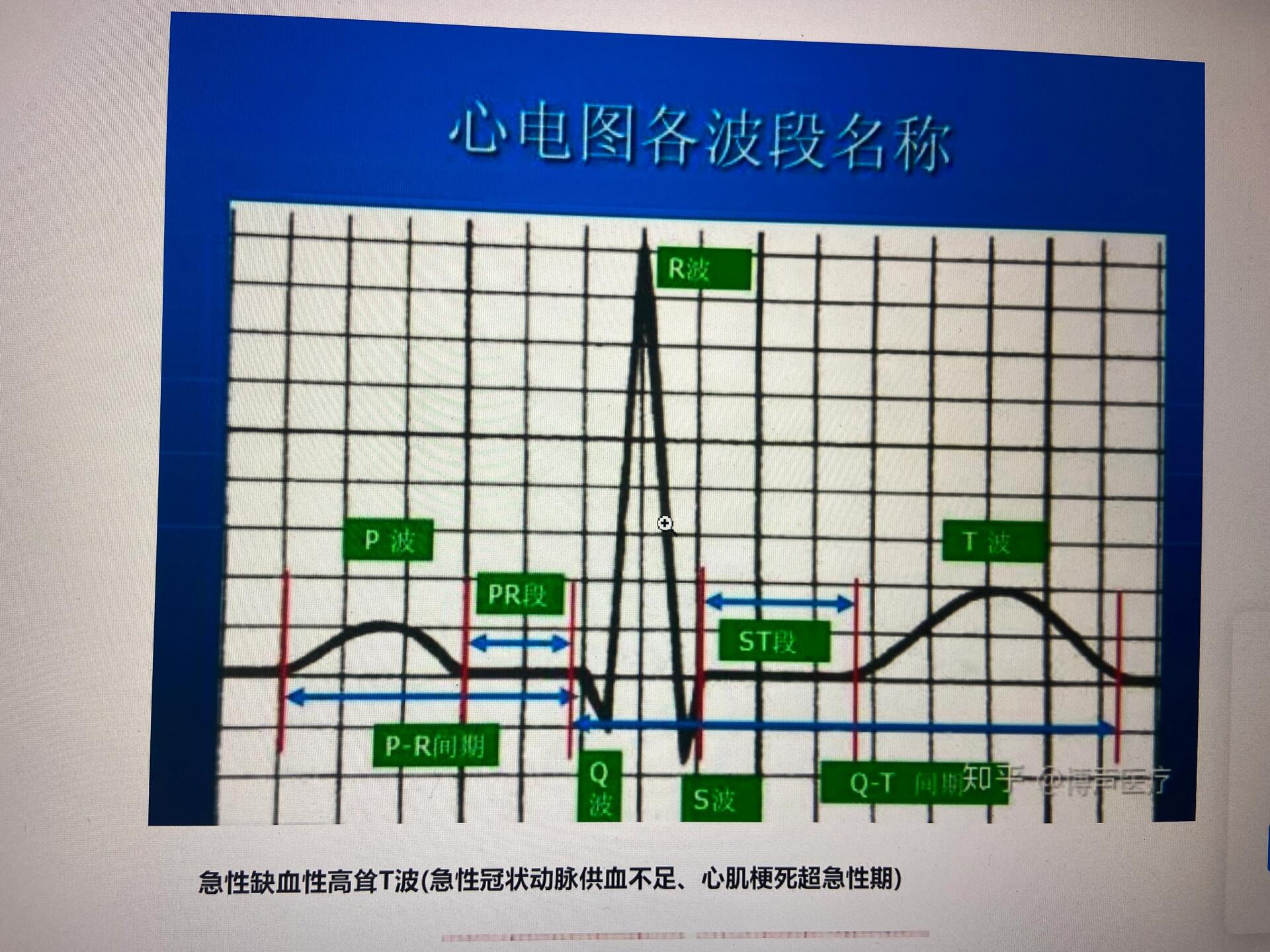 高尖t波心电图表现图片