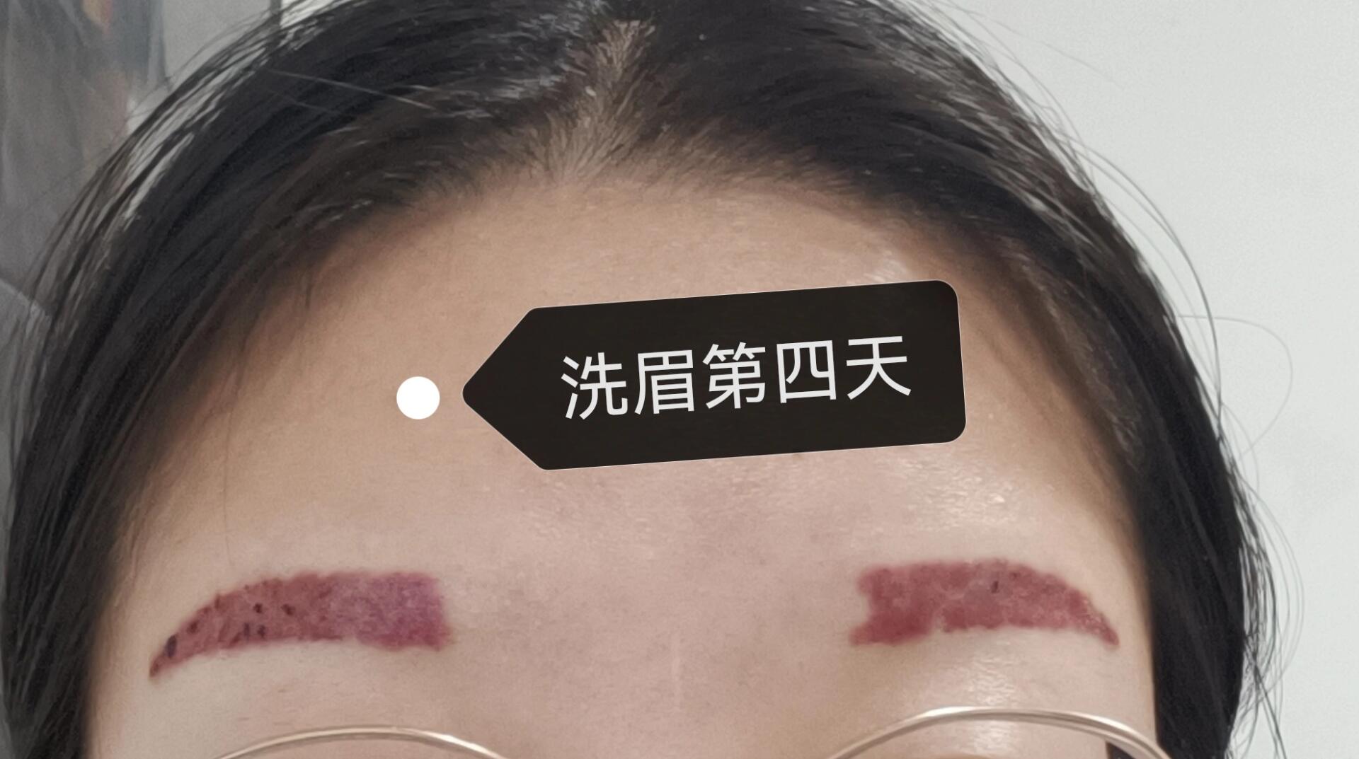 第一次洗红眉记录一下99 第一天激光洗完眉毛后的一个小时内,眉毛就