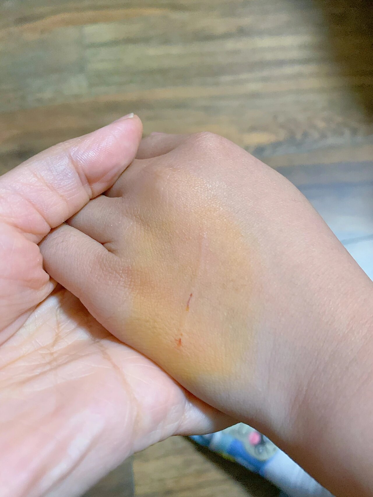 孩子被宠物猫抓伤🐈