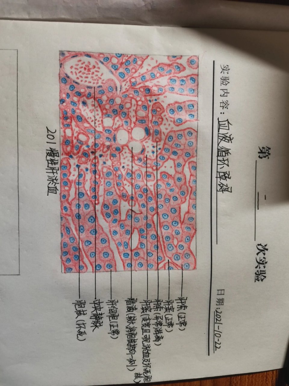 病理红蓝铅笔手绘图——局部血液循环障碍 99肝淤血 99肺淤血