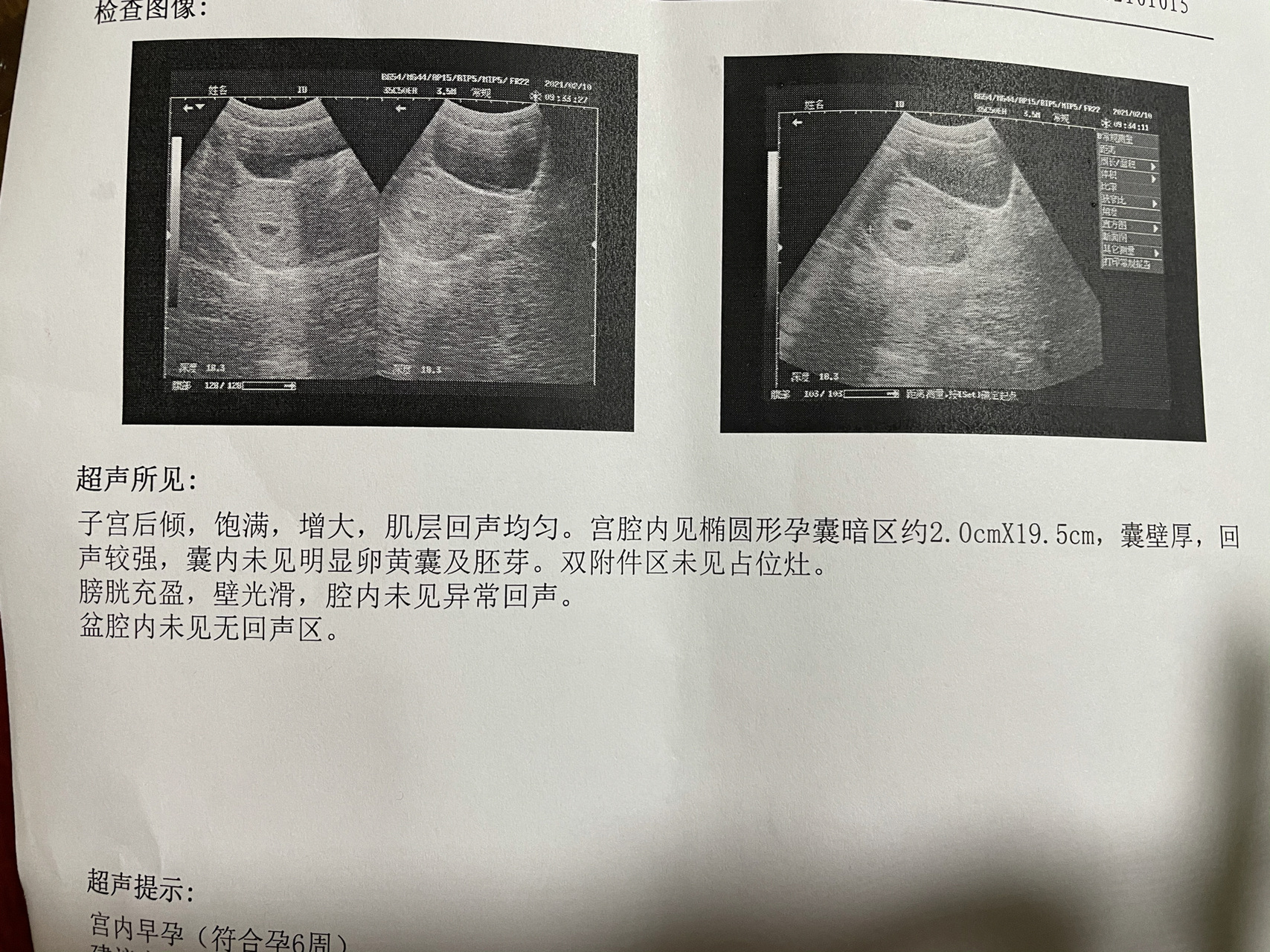 椭圆型孕囊图片图片