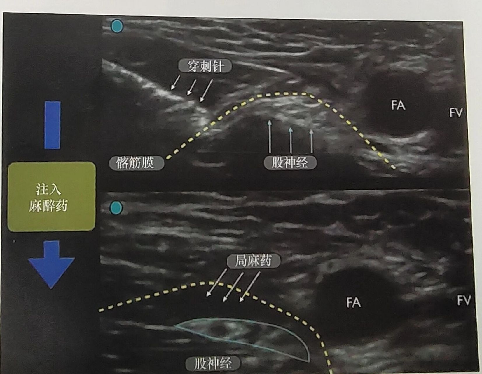 股神经阻滞麻醉图片