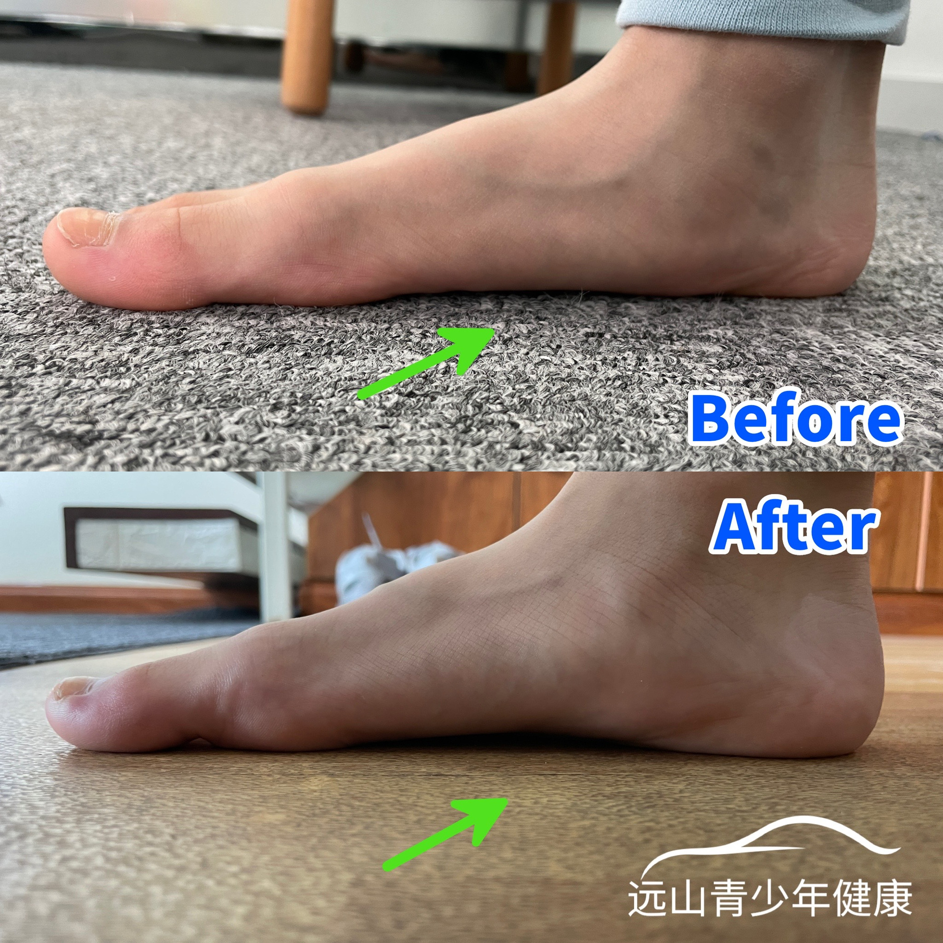 8岁男孩骨盆前倾怎么办