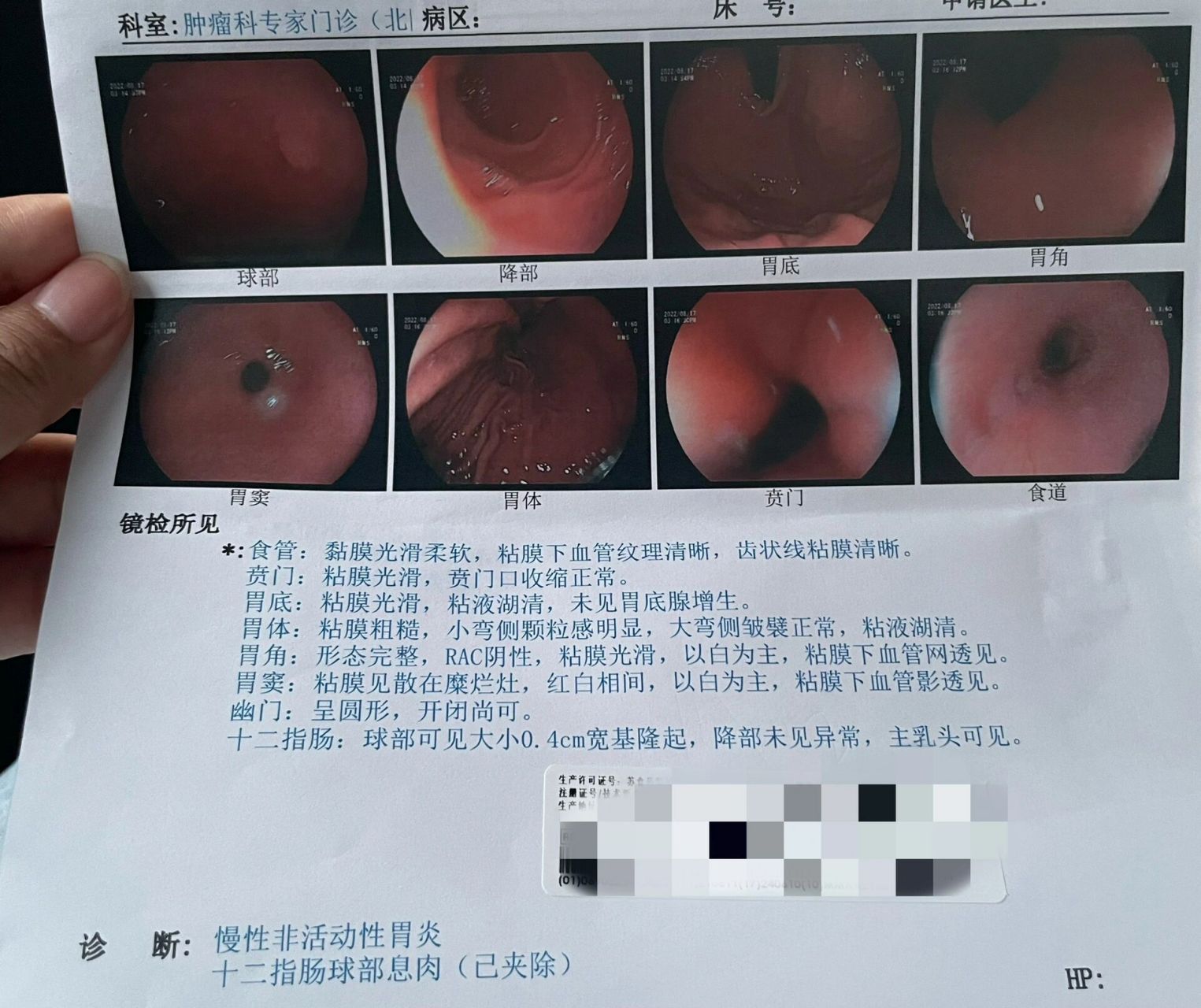 糖链抗原ca72-4偏高77胃肠镜经历 8月份公司组织了体检,最后查出