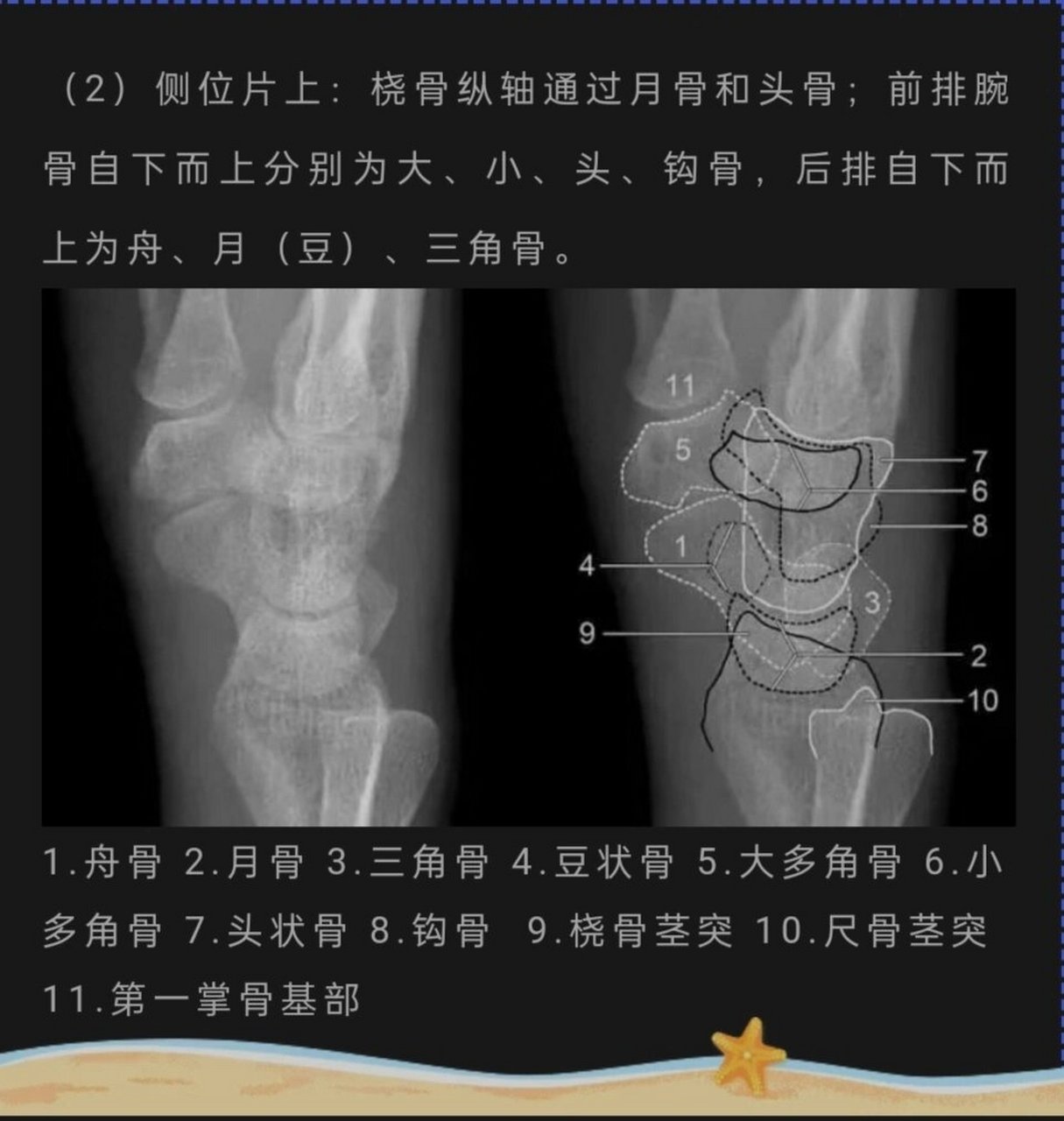 腕骨间关节图片